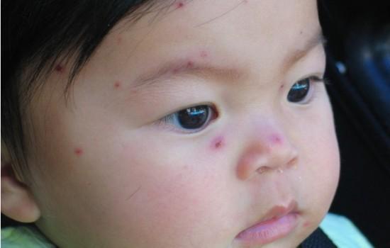 水痘可以吃小瓜,小瓜助力健康恢复